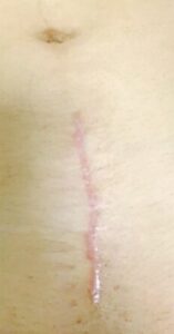 帝王切開　術後3ヶ月の傷跡（縦切り）